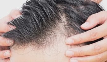 greffe de cheveux hongrie