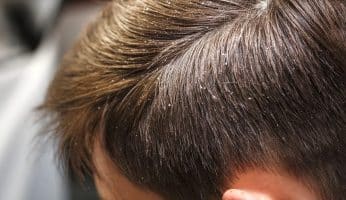 lutter contre pellicules homme