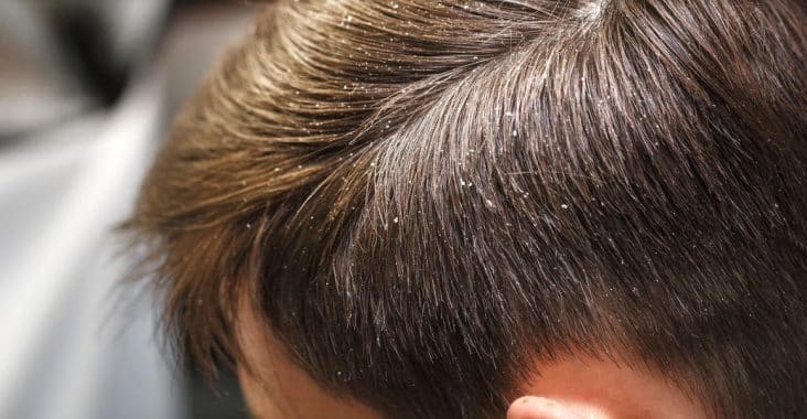 lutter contre pellicules homme