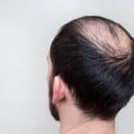 solutions calvitie cheveux clairsemés homme