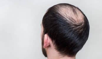 solutions calvitie cheveux clairsemés homme