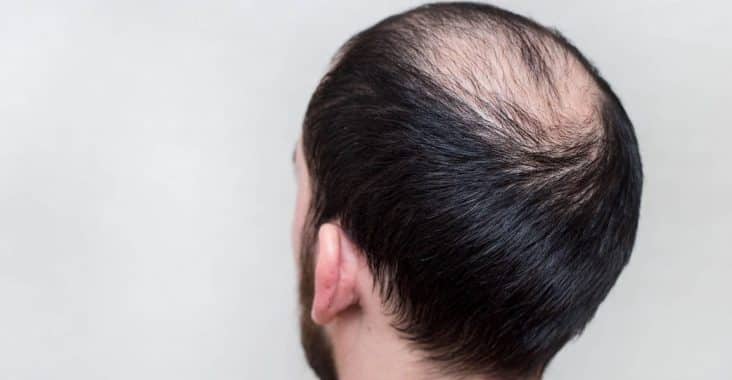solutions calvitie cheveux clairsemés homme