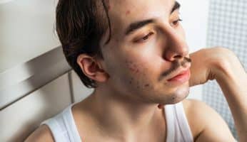 traiter acné homme